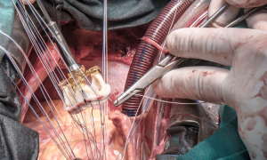 Transcatheter Heart Valve Replacement (THVR) Market - 2030
